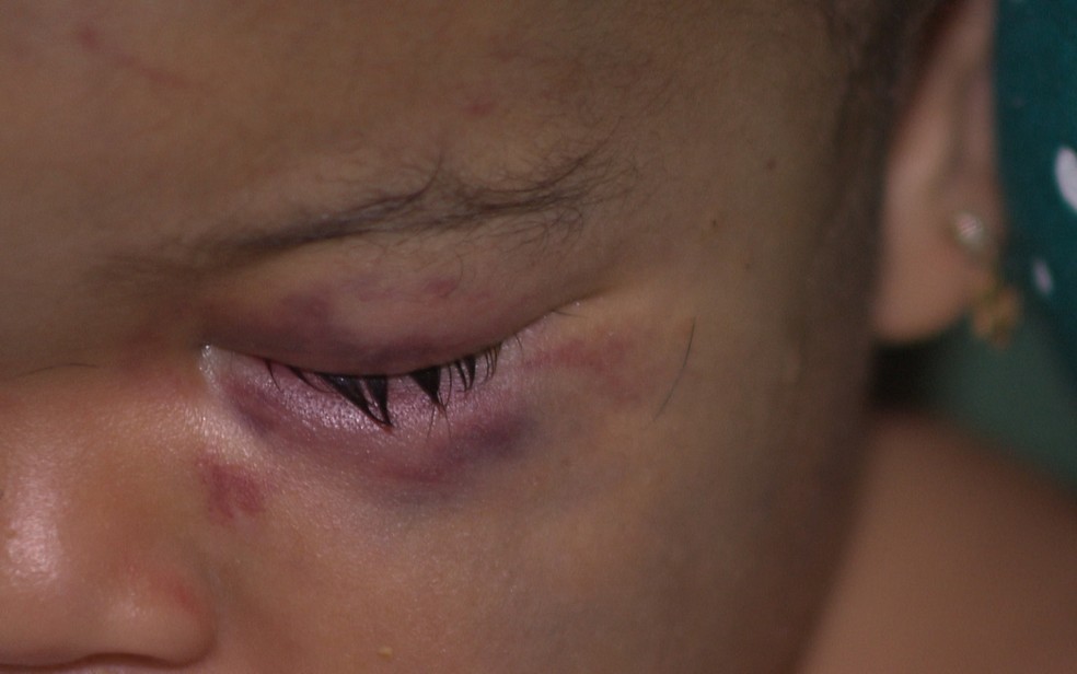 Bebê deu entrada em hospital com traumatismo craniano e hematomas no rosto (Foto: Reprodução/TV Paraíba)