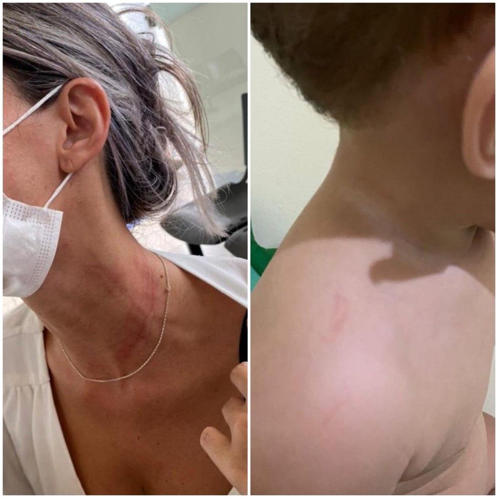 Marcas da agressão no corpo de Nayara Oliveira e do filho — Foto: Arquivo pessoal