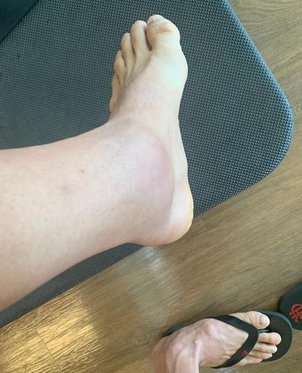 Irmão de Rafinha mostra pé muito inchado após lesão — Foto: Reprodução / Instagram