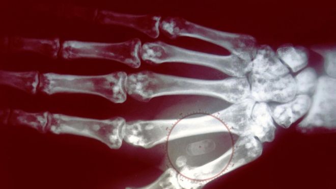 Você implantaria um chip na mão para pagar sem cartão? (Foto: Getty Images via BBC News Brasil)