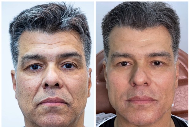 Mauricio Mattar e o antes e depois da harmonização facial (Foto: Instagram/Reprodução)