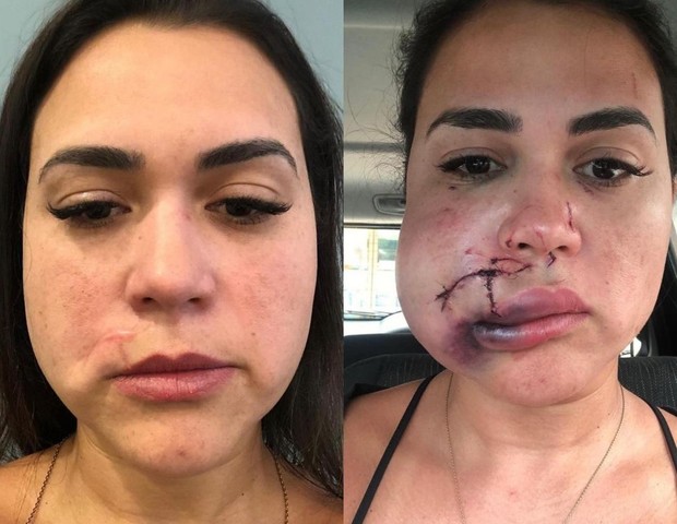 Milka Borges precisou passou por quatro cirurgias faciais após agressão  (Foto: Arquivo pessoal)