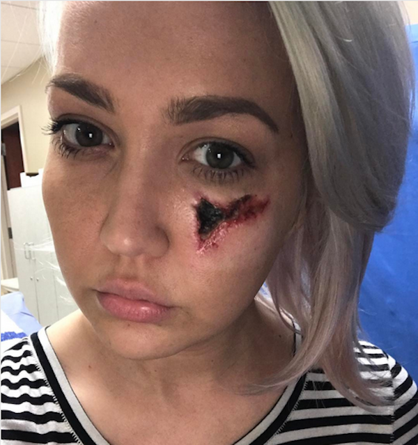 A cantora Meghan Linsey com a ferida decorrente da picada da aranha (Foto: Instagram)