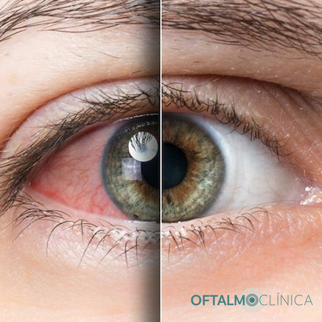 Olhos secos: o que significam?