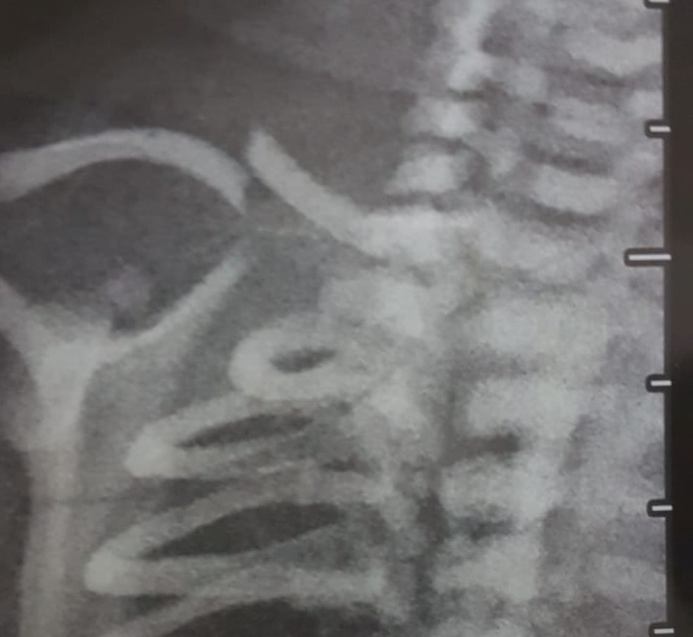 Foto do Raio-x do recém-nascido que teve a clavícula quebrada no DF — Foto: Arquivo pessoal