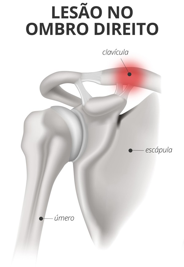 Diego Alves sofre fratura na clavícula  desfalca o Fla e pode passar por cirurgia