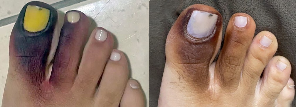 Antes e depois do p&eacute; de Thassynara, atingida por toxina de piolho-de-cobra &mdash; Foto: Reprodu&ccedil;&atilde;o