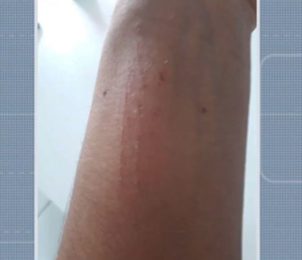 Mulher ficou com arranhões no braço após médica de Jaguarari tentar tirar celular das mãos dela — Foto: Reprodução/TV São Francisco