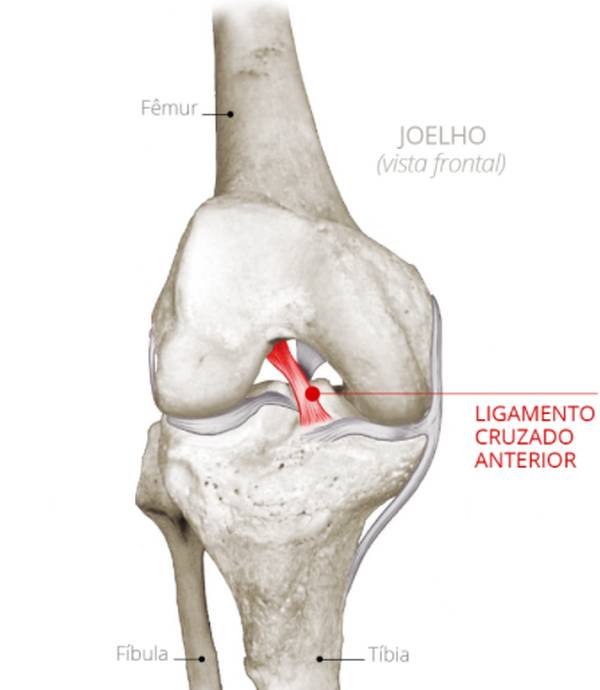 ruptura-do-ligamento-cruzado-anterior-do-joelho-por-que-operar
