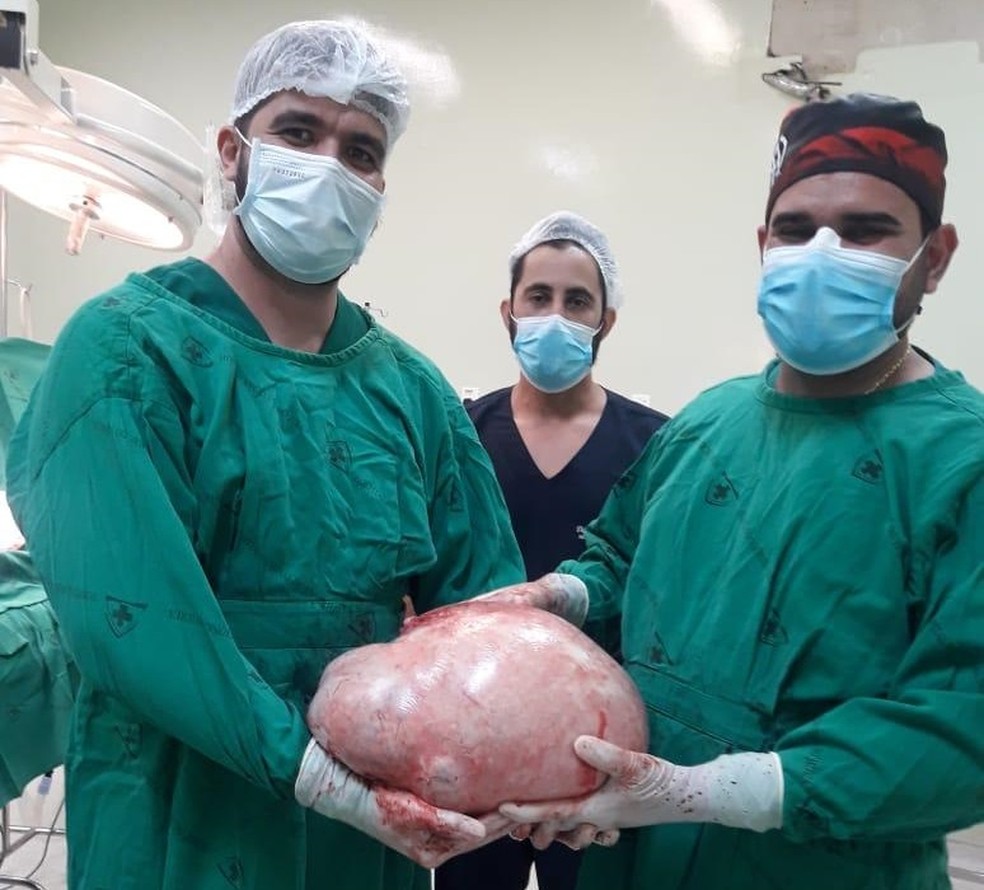 Tumor de quase 20 quilos é retirado do ovário de paciente em Cruzeiro do Sul — Foto: Arquivo pessoal