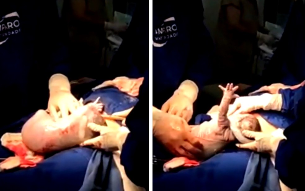 Bebê rompe película com a própria mão após o nascimento em Goiânia, Goiás — Foto: Montagem/g1