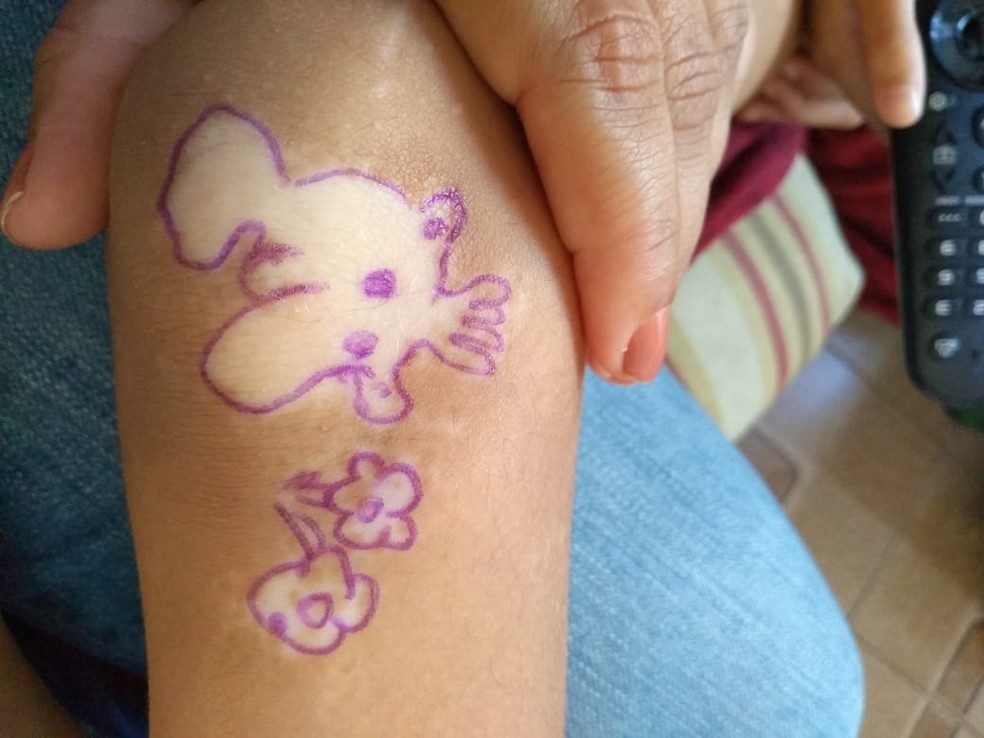 Maria Luiza faz desenhos com manchas provocadas pelo vitiligo. — Foto: Arquivo pessoal