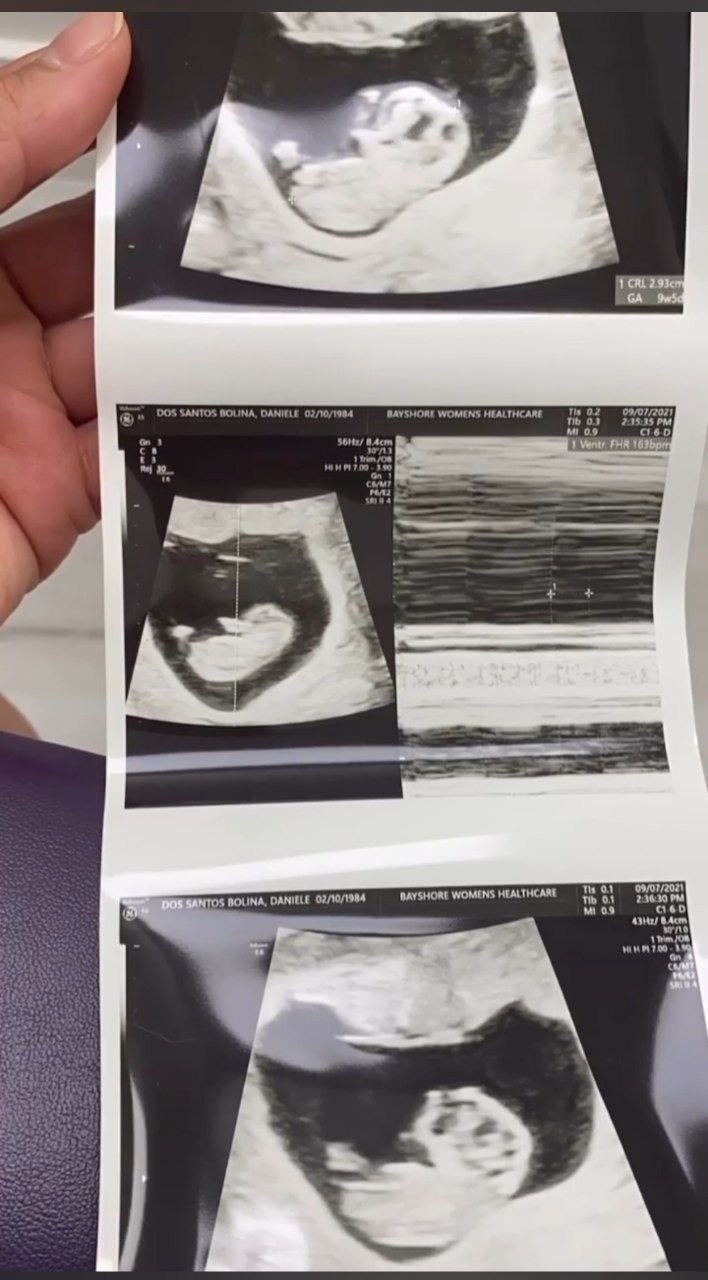 Dani Bolina mostra ultrassom da gravidez (Foto: Reprodução/Instagram)