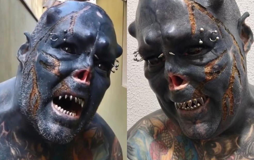 Após mutilar nariz, orelhas e dentes, 'Caveira' do interior de SP queima pele do rosto em novo procedimento: 'Dor é extrema'