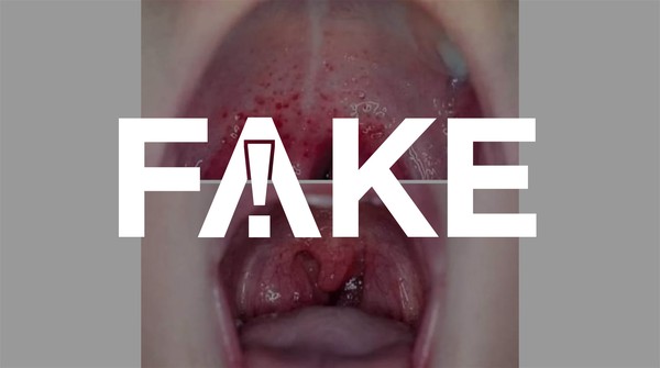 E Fake Que Foto Mostre Amigdalas De Paciente Com Covid 19 Coronavirus G1