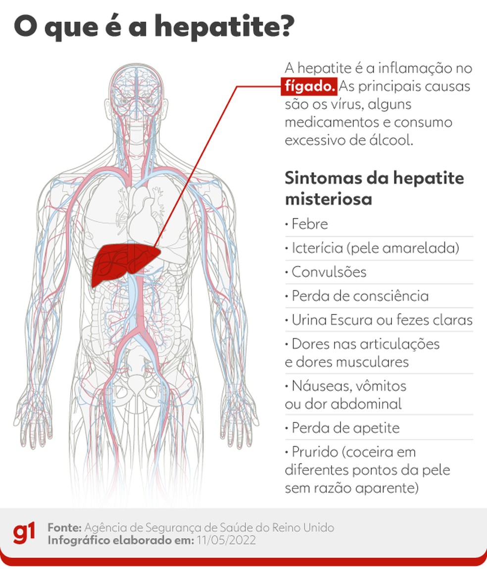 Hepatite: o que é? Veja sintomas da hepatite misteriosa — Foto: Arte/g1