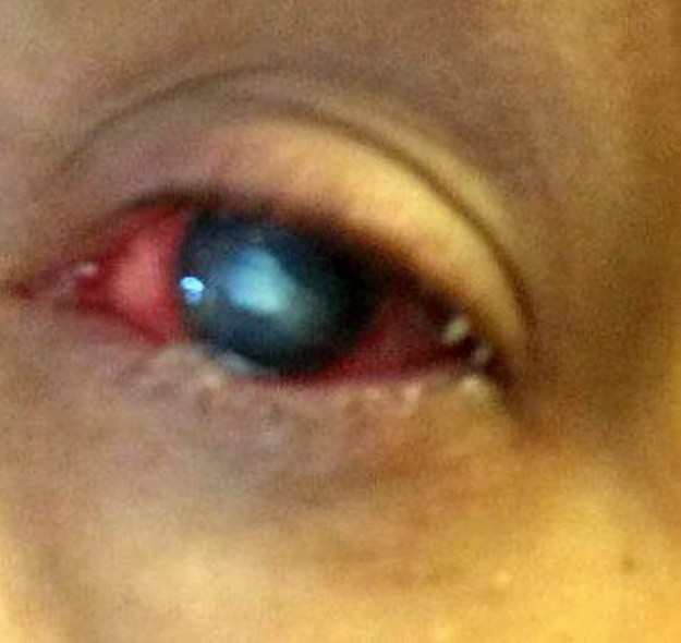 o olho infectado de jessica, no auge (Foto: reprodução - tab)