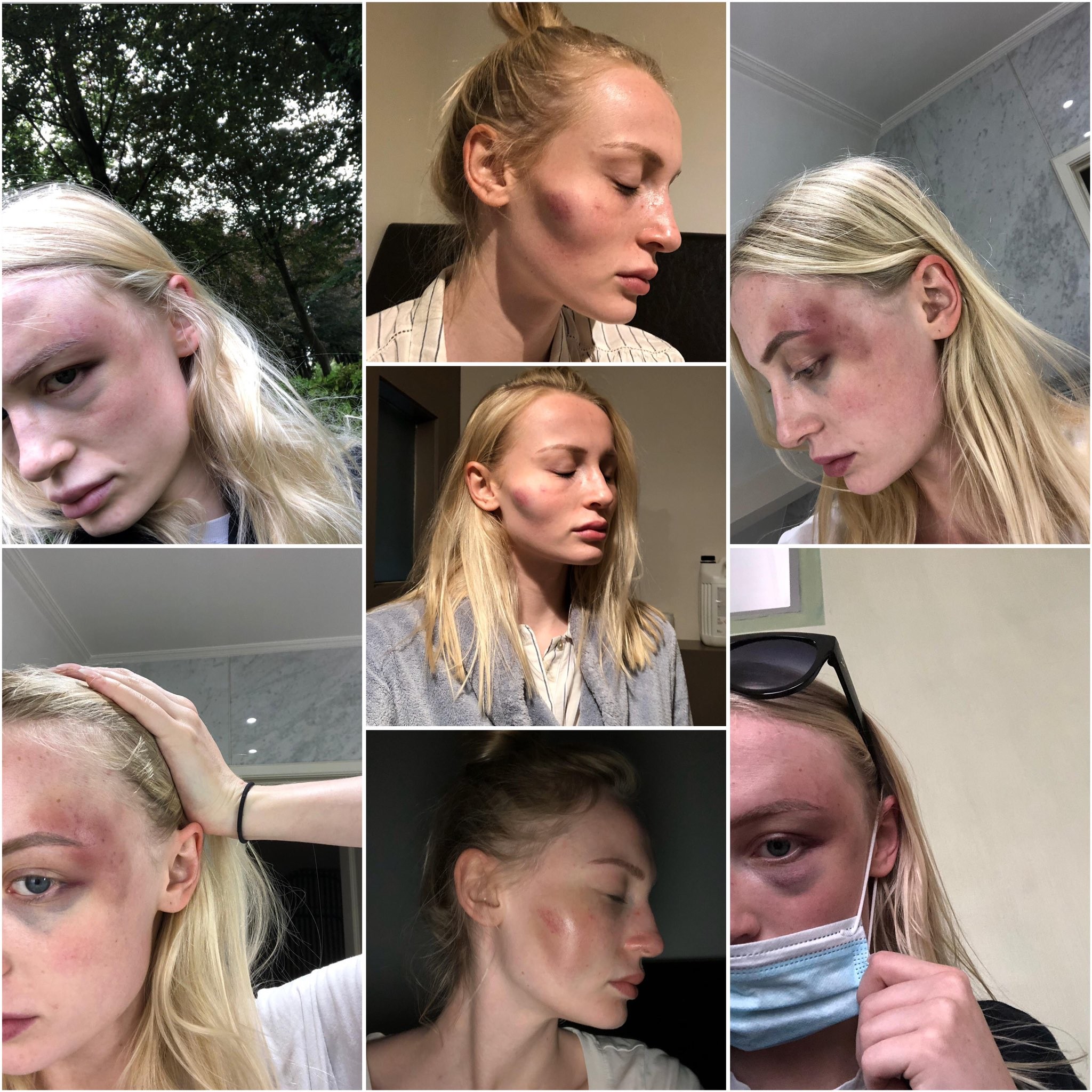 As fotos compartilhadas pela modelo belga Anthonia Rochus mostrando as lesões causadas pelas agressões cometidas por seu ex-namorado (Foto: Twitter)