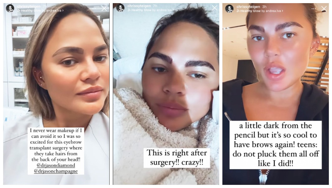 Os posts da modelo e apresentadora Chrissy Teigen após passar por um transplante de sobrancelhas (Foto: Instagram)