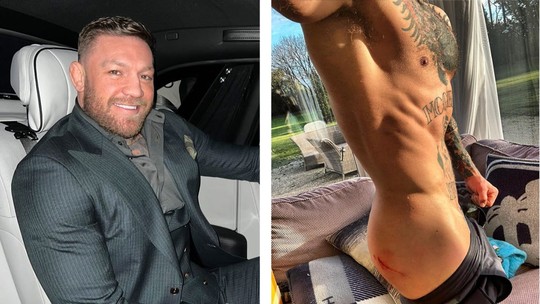 Conor McGregor mostra ferimento após ser atropelado por carro e fãs reclamam de foto 'indiscreta'