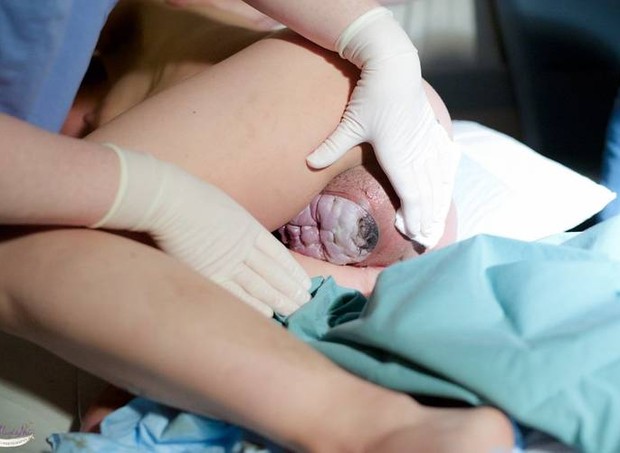 Apresentação de face: quando o bebê mostra primeiro o rosto no parto (Foto: Samantha Garcia Gagnon)
