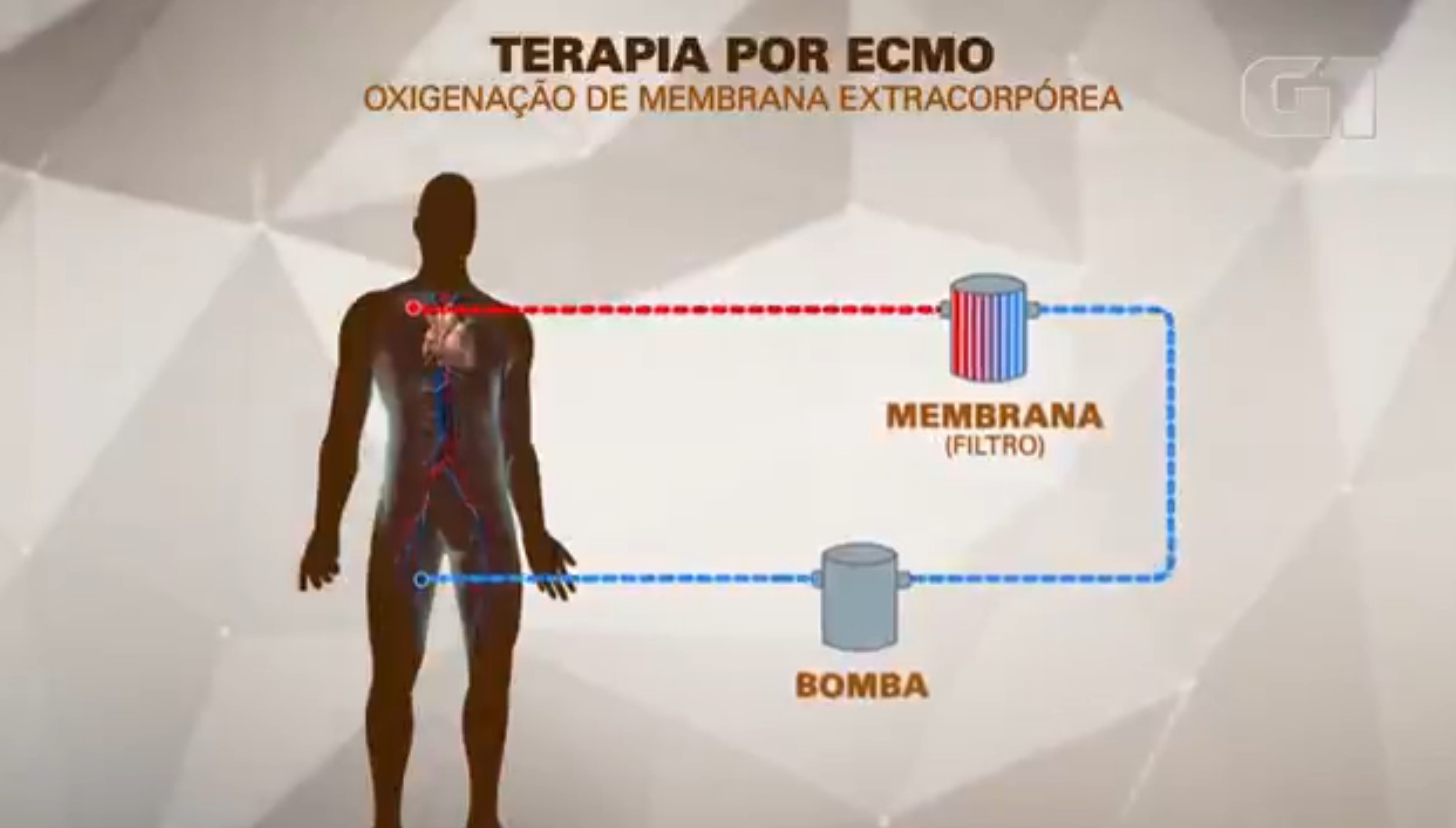 MC Marcinho usa terapia conhecida como ECMO, espÃ©cie de pulmÃ£o artificial; entenda como funciona