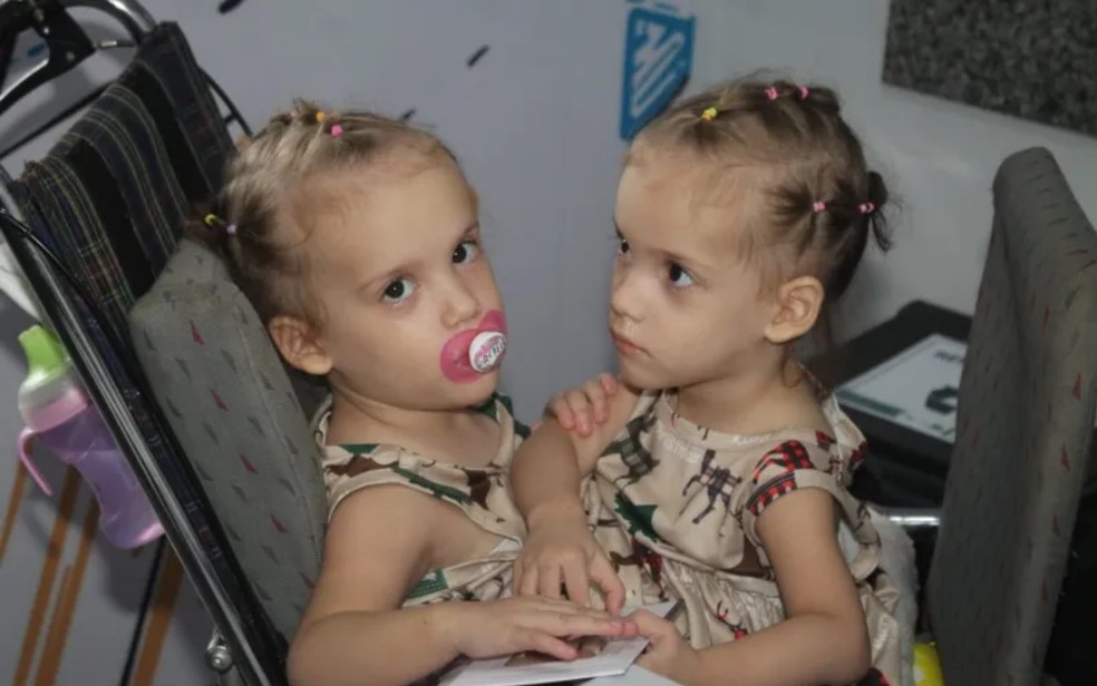 Gêmeas siamesas Valentina e Heloá Prado, de três anos: fazem separação em Goiânia, Goiás — Foto: Divulgação/Zacharias Calil