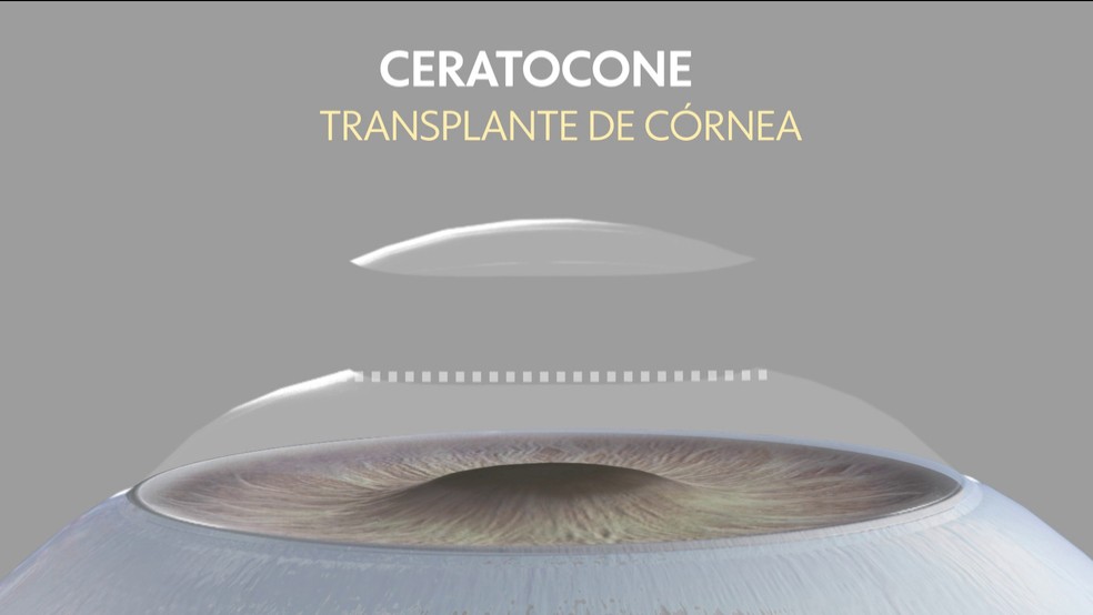 20% dos transplantes de córnea, feitos no Brasil, são por causa da doença, diz Conselho Brasileiro de Oftalmologia.