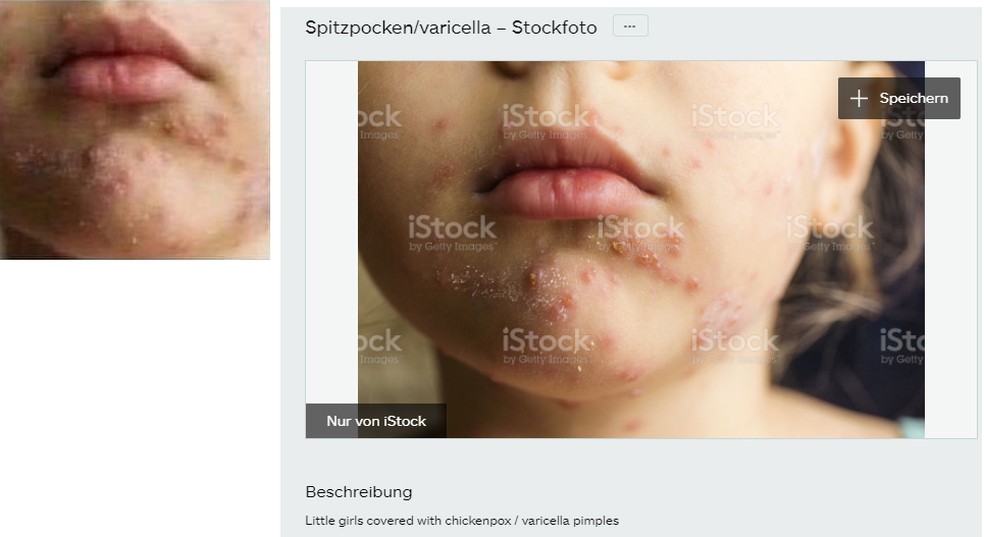 Imagem mostra criança com varicela e não lesão por uso de máscara; foto está disponível em banco de imagens — Foto: Reprodução