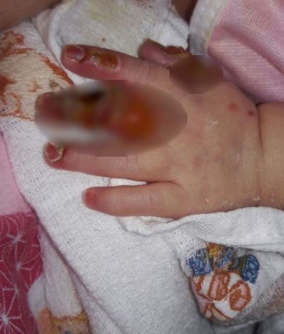 Yasmin sofre com as dores que as bolhas causam, conta a mãe (Foto: Arquivo pessoal )