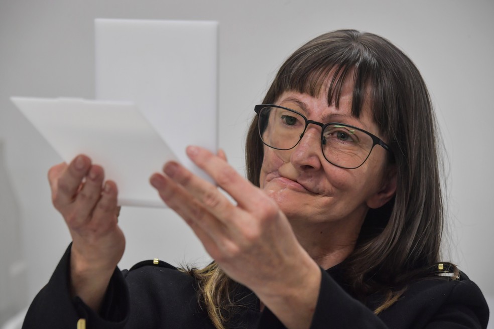 Paciente com prótese de rosto feita em impressora 3D se olha no espelho — Foto: Nelson Almeida/AFP