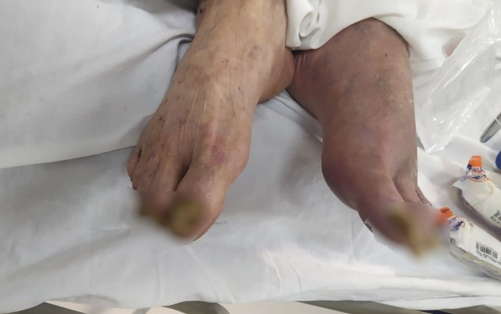 Unhas do pé do idoso encontrado em situação precária descuidadas e sujas — Foto: Reprodução/TV Anhanguera