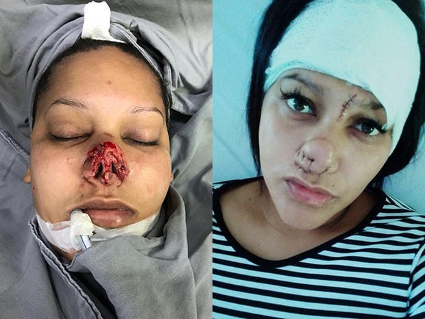 Talita Oliveira logo após a violência e após cinco cirurgias plásticas (Foto: Arquivo pessoal)