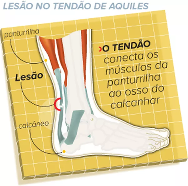 Tendao De Aquiles Correr Nas Pontas Dos Pes E Perigoso E Pode Causar Tendinopatia Eu Atleta Ge