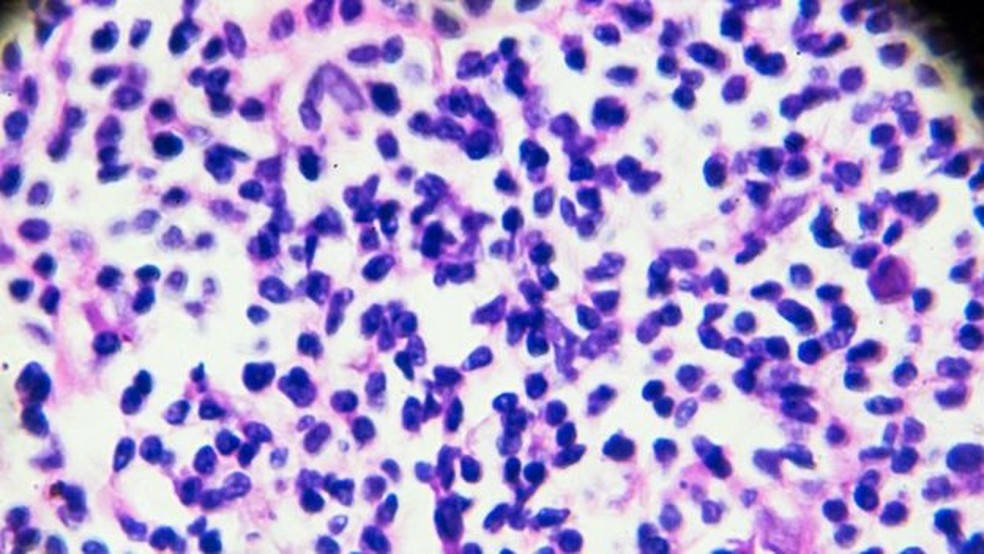 Células do linfoma de Hodgkin; Michelle demorou a obter um diagnóstico da doença — Foto: Getty Images/BBC