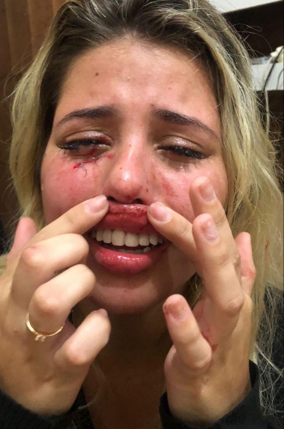 Amanda Souza mostra machucados e denuncia terem sido feitos por Vanderlei