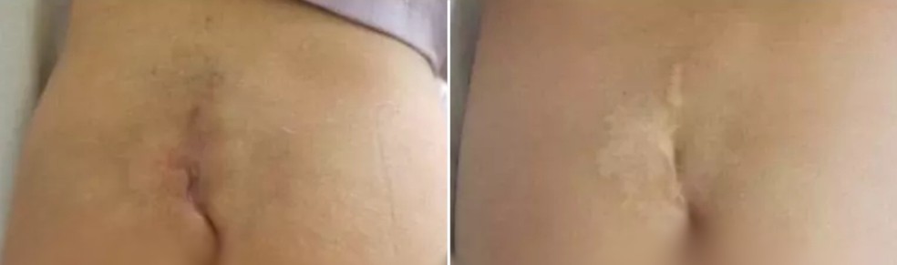 Cauda foi retirada atrav&eacute;s de cirurgia em Jundia&iacute; &mdash; Foto: Journal of Pediatric Surgery Case Reports/Reprodu&ccedil;&atilde;o