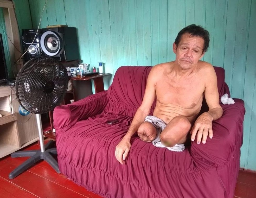 Homem teve que amputar as duas pernas apÃ³s ter complicaÃ§Ãµes com um quadro grave de diabetes â Foto: Adelcimar Carvalho/G1