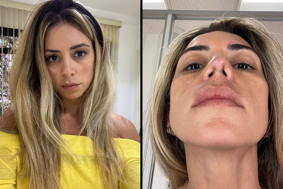 Fotos antes e depois de Paula Oliveira, uma das pacientes que relatam impactam impactos negativos, mesmo um ano após a rinoplastia — Foto: Arquivo Pessoal