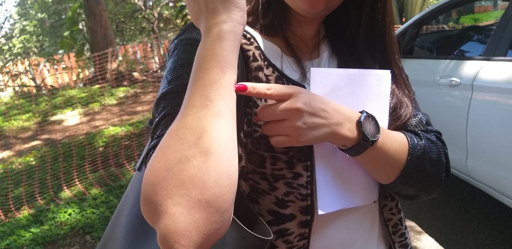 Mulher agredida mostra braço com ferimentos leves e hematomas depois de ser agredida dentro de bar — Foto: Alex Araújo/G1