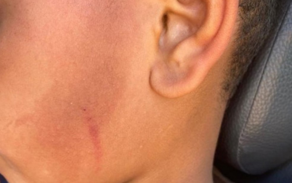 Criança de 8 anos com hematomas no rosto após ser espancada em Anápolis, Goiás — Foto: Reprodução/TV Anhanguera