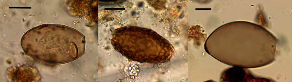 Kapilláris máj paraziták - Urticaria giardiasisban