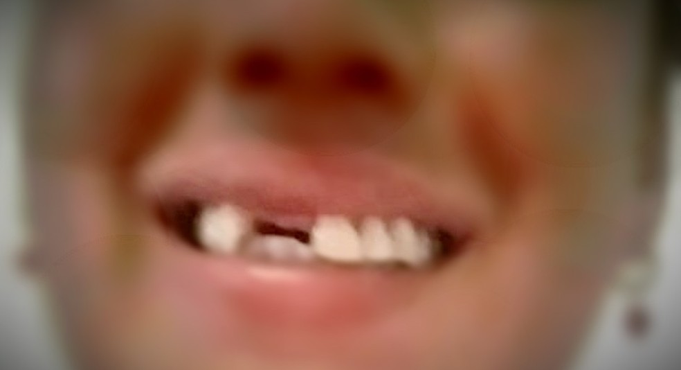 Mulher fez uma selfie para mostrar os dentes arrancados pela agressão sofrida — Foto: Arquivo pessoal