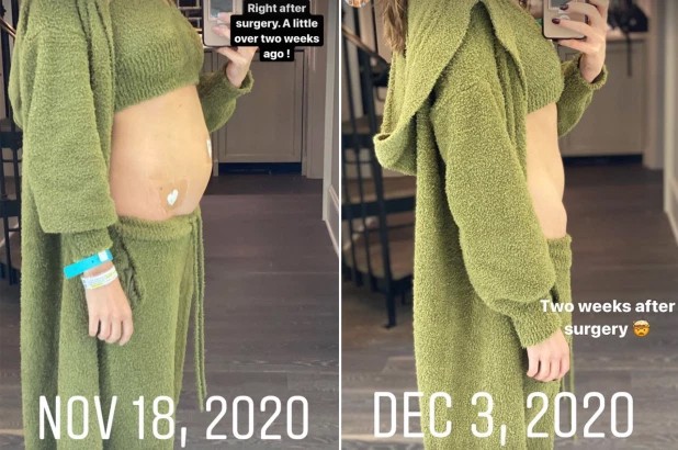 Olivia Culpo mostra as mudanças no seu corpo após fazer cirurgia para tratar a endometriose (Foto: Reprodução / Instagram)