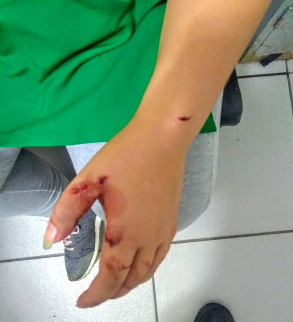 Mulher ficou com mÃ£o machucada  â€” Foto: G1 Santos