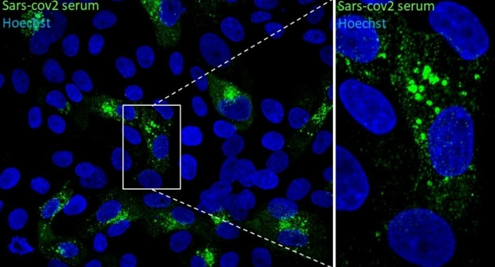 Microscopia de imunofluorescência de células Vero-E6 infectadas com SARS-CoV-2. No campo de maior ampliação (direita) é possível observar as vesículas em detalhes (Foto: Edison Durigon/ICB-USP)