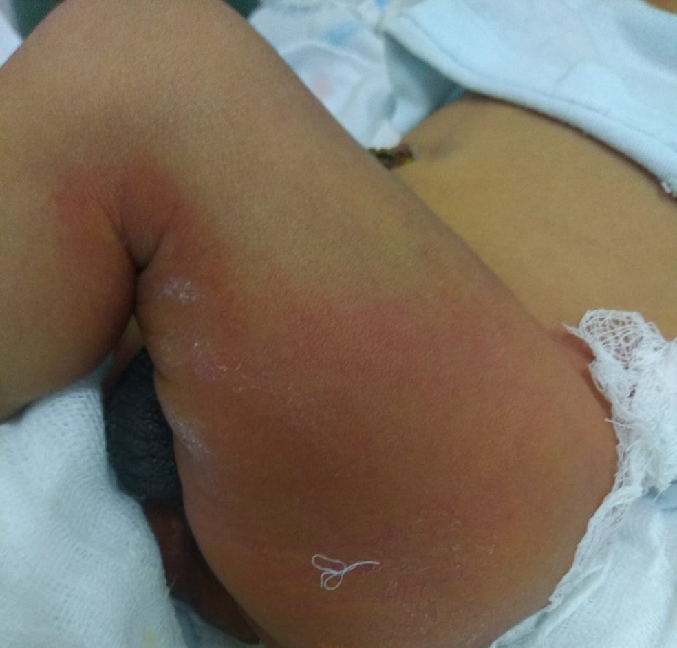 Pernas e costas da criança ficaram queimadas após banho — Foto: Arquivo pessoal