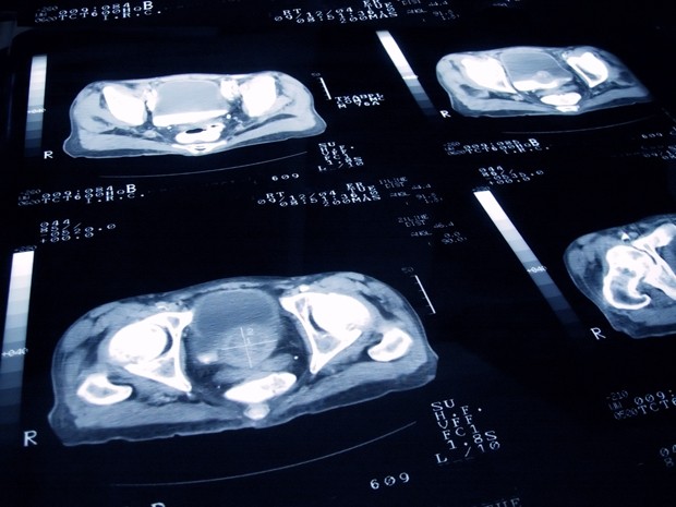 Diagnóstico do câncer de próstata pode estar relacionado a vários aspectos da sua vida: alimentação, histórico familiar, tabagismo e até hiperglicemia (Foto: Getty Images)