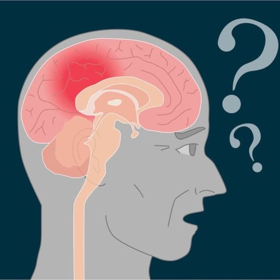 DoenÃ§a de Alzheimer atinge regiÃ£o do cÃ©rebro que fixa as informaÃ§Ãµes novas (Foto: Getty Images)