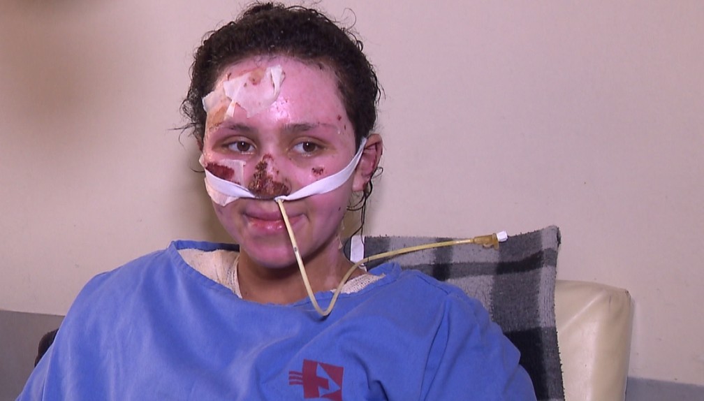 A adolescente Jackeline de Andrade, de 16 anos, queimou 60% do corpo ao resgatar o irmÃ£o em um incÃªndio â?? Foto: ReproduÃ§Ã£o/RPC